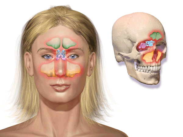 How to get rid of a sinus headache