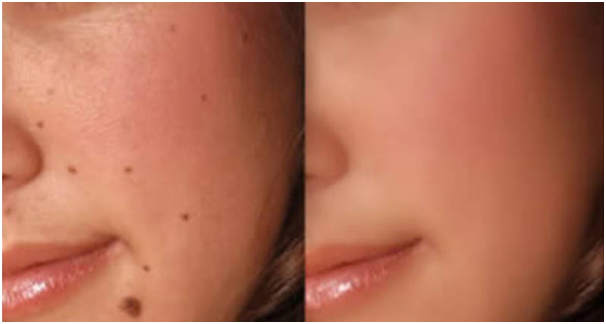 home remedies to remove moles