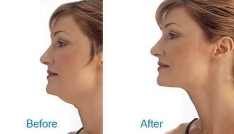How to Get Rid of Neck Fat 