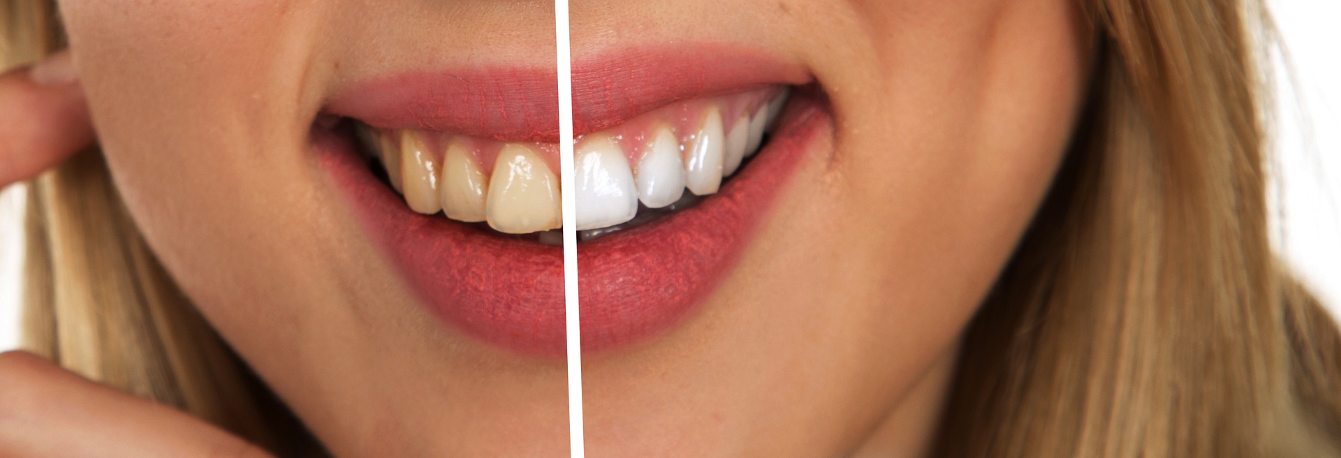 Teeth whitening home remedies